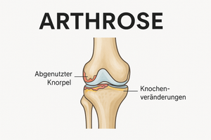 Arthrose verstehen – Ursachen, Symptome &amp; die besten Hilfsmittel aus dem Sanitätshaus